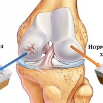 Cum de a restabili cartilajului