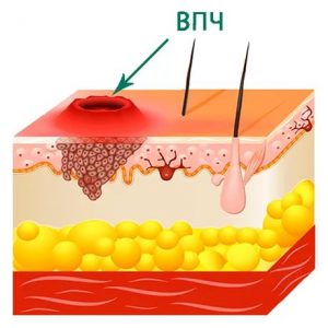 HPV la barbati