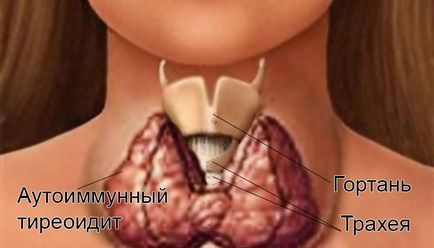 Ce este tiroidita cronică autoimună