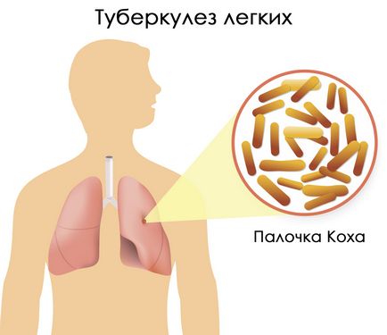 Forma închisă a tuberculozei, care este