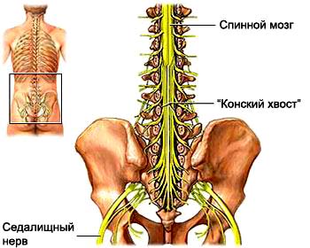 Ce se poate face în cazul în care durerea nervului sciatic