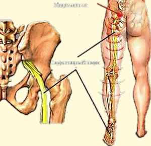 Un tratament nerv sciatic prins