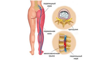 Ce se poate face în cazul în care durerea nervului sciatic