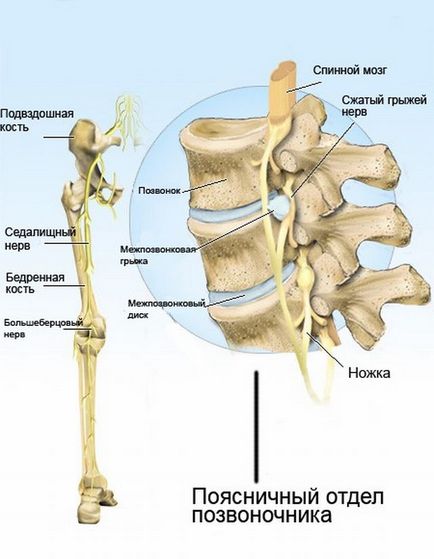 Un tratament nerv sciatic prins