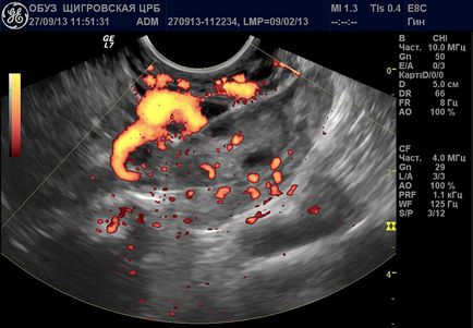 Ce este corpus luteum pe ultrasunete