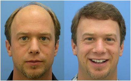 5 motive pentru aspectul de chel patch-uri pe frunte de bărbați și 2 moduri de a face cu ei - haircutmen
