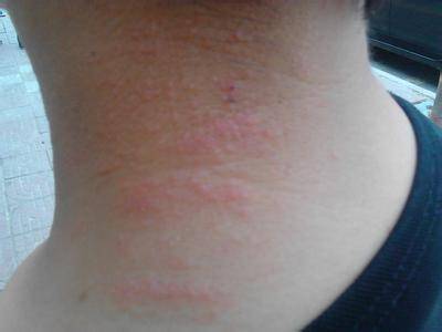 scalpului prevenirea și tratamentul alergiilor