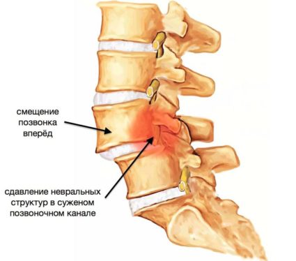 Antelistez vertebra L5; ce este, cum să se manifeste și tratate