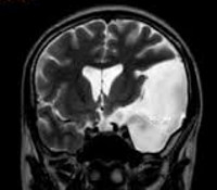 chisturi arahnoidici ale creierului - cauze, simptome, diagnostic și tratament