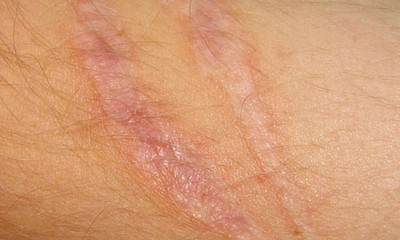cicatrici atrofice (cicatrici) cicatrici atrofice