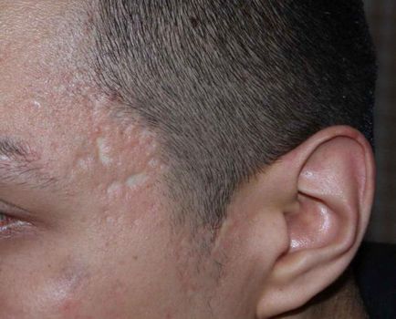cicatrice atrofică pe fața cauzelor, caracteristicile și tratamentele