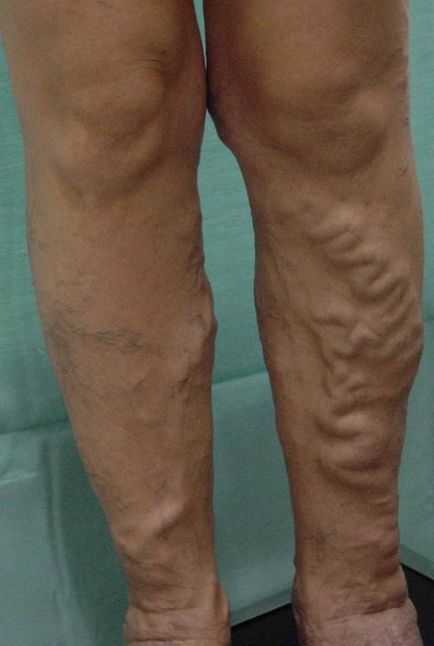 Durere cu varice - cum pentru a calma durerea în venele picioarelor, site-ul medical