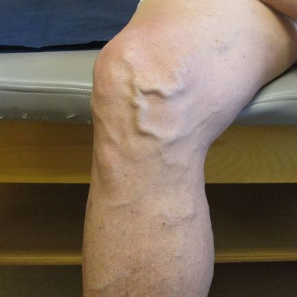 Durere cu varice - cum pentru a calma durerea în venele picioarelor, site-ul medical