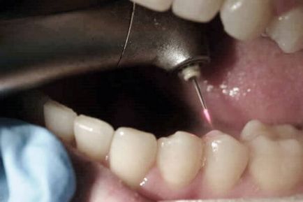 Domeniul de aplicare dentare de foraj, tipuri, costuri