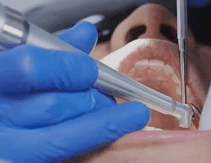 Domeniul de aplicare dentare de foraj, tipuri, costuri