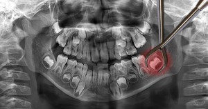 Clåtirea gura dupa o interventie chirurgicala pentru a elimina un dinte