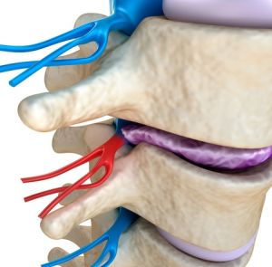 Ce este scleroza subcondral a suprafețelor articulare și plăcile de capăt ale corpurilor vertebrale