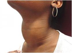 Care este glanda tiroidă
