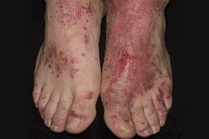 Disgidroticheskaya cauze eczeme, unguente, remedii de tratament populare
