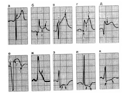 Fireaid electrocardiografe - ECG (patologie atrială (p) și ventriculare (QRS, st)
