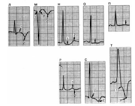 Fireaid electrocardiografe - ECG (patologie atrială (p) și ventriculare (QRS, st)