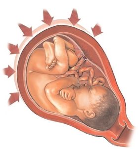 Hipertonicitate miometru față, peretele din spate al uterului în timpul sarcinii cauzează pericol