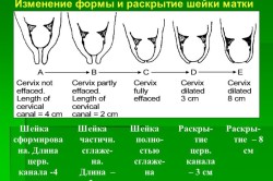 Miometriala hipertonus cauze, simptome și tratament