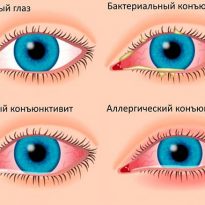Picături pentru ochi din preparate de revizuire conjunctivită