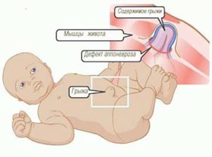 Hernia in simptomelor nou-născut, tratamentul și prevenirea