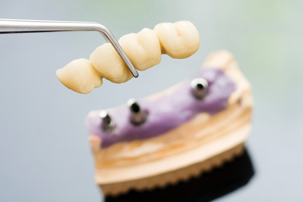 Implanturile dentare au rang mai bine clinici