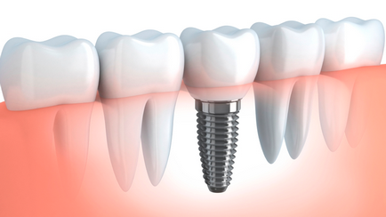 Implanturile dentare au rang mai bine clinici