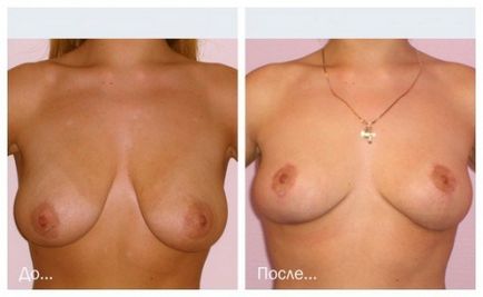 Cum indicații și contraindicații Ridicarea sânilor cu fotografii înainte și după