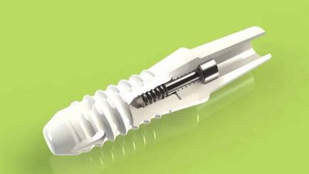Ce dintii implanturi mai bine pentru a pune pe dinti de mestecat