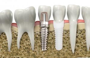 Ce mai bine dintii implanturi (implanturi)