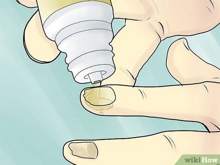 Cum sa scapi de unghii ciuperca