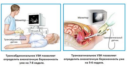 Cum de a identifica o sarcina extrauterina în stadii incipiente de diagnostic și de detectare în stadii incipiente