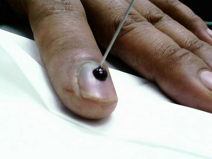 Cum să aibă grijă de degetul în cazul în care cuiul ar trebui sa oprit din cauza unei accidentări