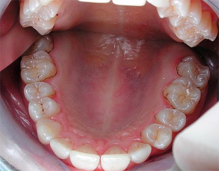 Cum de a proteja dintii de carii și pentru a preveni apariția