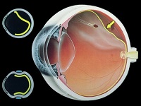 Pro corectarea vederii cu laser și contra de recuperare chirurgie
