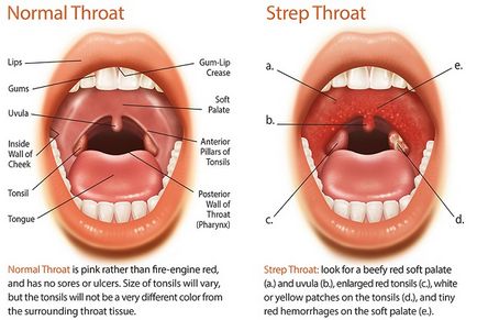 Tratamentul durerilor de gât cu antibiotice