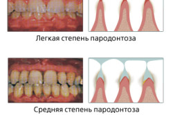 Tratamentul cu laser periodontitei
