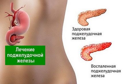 remedii pancreatice Tratament popular - longevitate sănătos