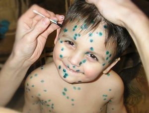 Este posibil să când și cum să se scalde copilul cu varicela