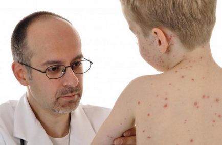 Pot să fac baie copilului cu varicela varicela a trecut atunci când se poate scălda copilul