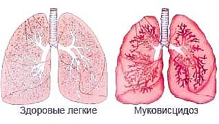 Fibroza chistica simptomelor copii și tratament