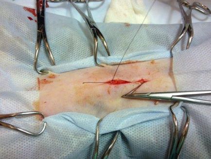 În ce zi după suturi chirurgicale sunt eliminate, grija pentru sutura post-operatorie