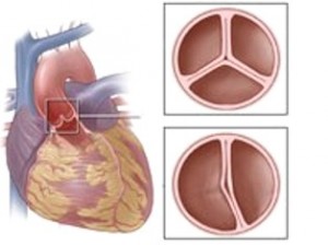 valva aortica 1, 2, 3 grade, tratament, simptomele și cauzele