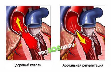 valva aortica 1, 2, 3 grade, tratament, simptomele și cauzele