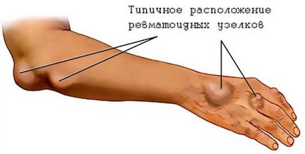 mână Umflarea în mână pentru a face, ceea ce este motivul și modul de a trata edem