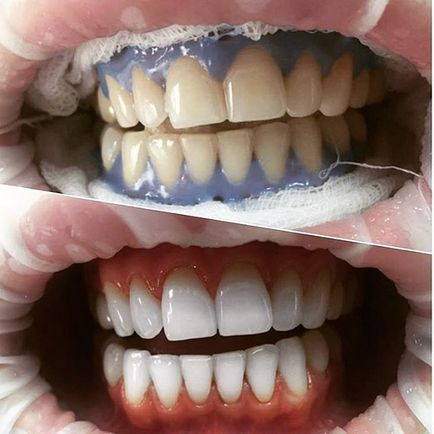 Albirea dinților profesioniști alb uimitoare și contra, pret, recenzii